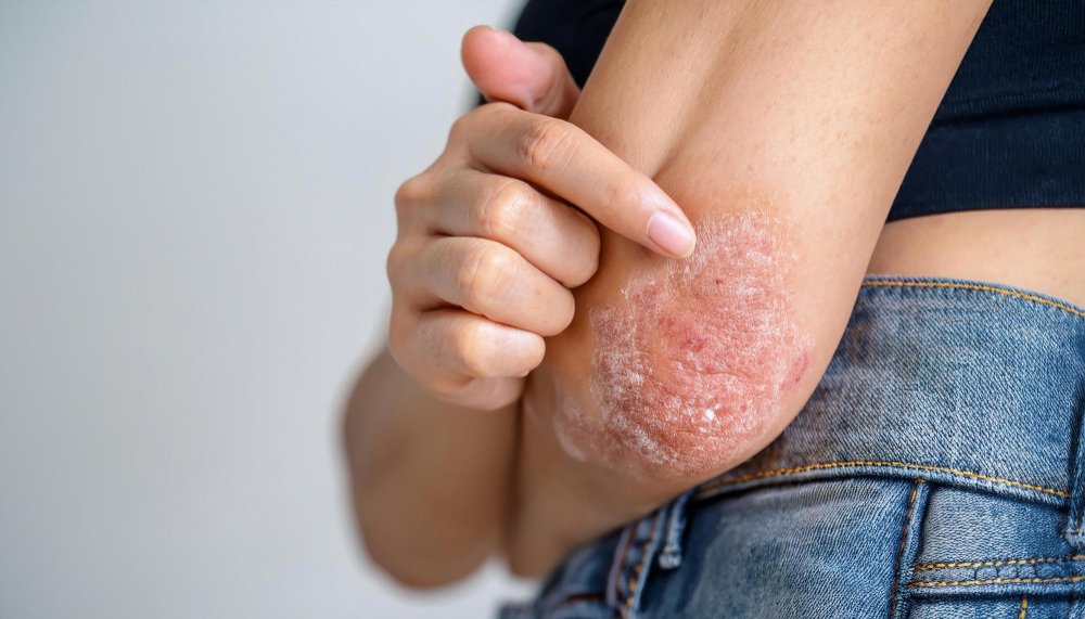 Huile de nigelle pour eczéma