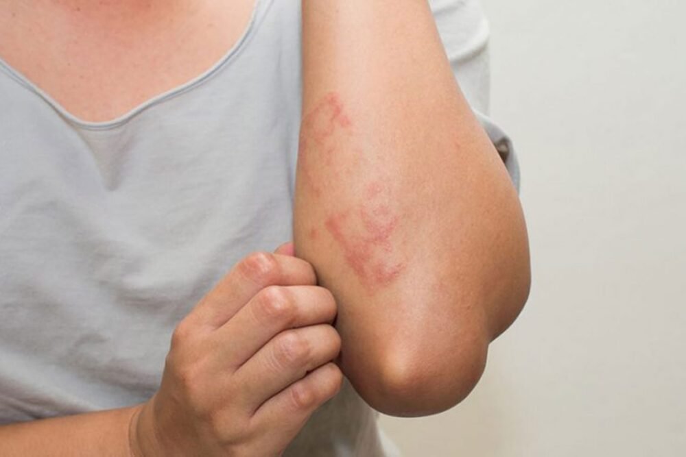 Sérum Apaisant Psoriasis et Eczéma